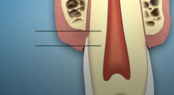 Crown Lengthening