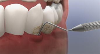Gingivitis and Periodontitis