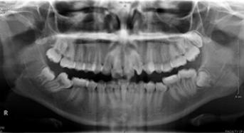 Analysis of a Panoramic Radiograph
