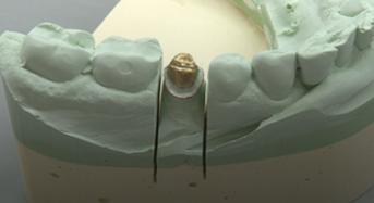 Crown and Bridge Master Model