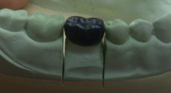 Wax-up Technique