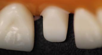 All Ceramic Crown Preparation