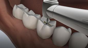 Cavity Preparations