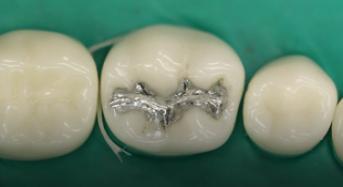 Class 1 Amalgam Restoration