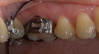Orthodontic Band Selection and Placement
