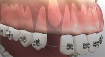 Periodontal Surgery For Impacted Canine Exposure