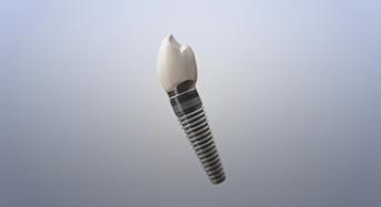 Single Tooth Implant Restoration
