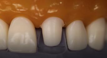 PFM Preparation on Anterior Tooth