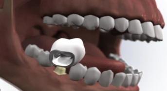 PFM Preparation On Posterior Tooth